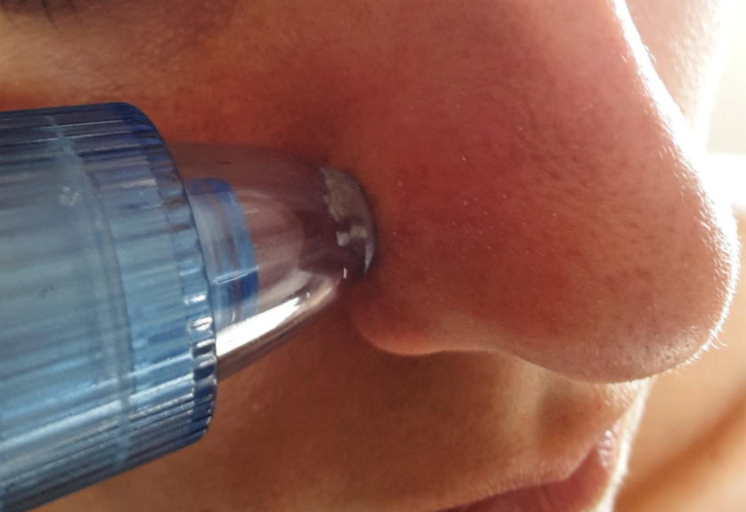 Aspirateur Points Noirs PureSkinSecrets™